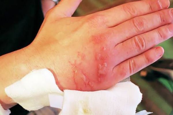 Можно применять для очистки любое масло, не подходит только облепиховое